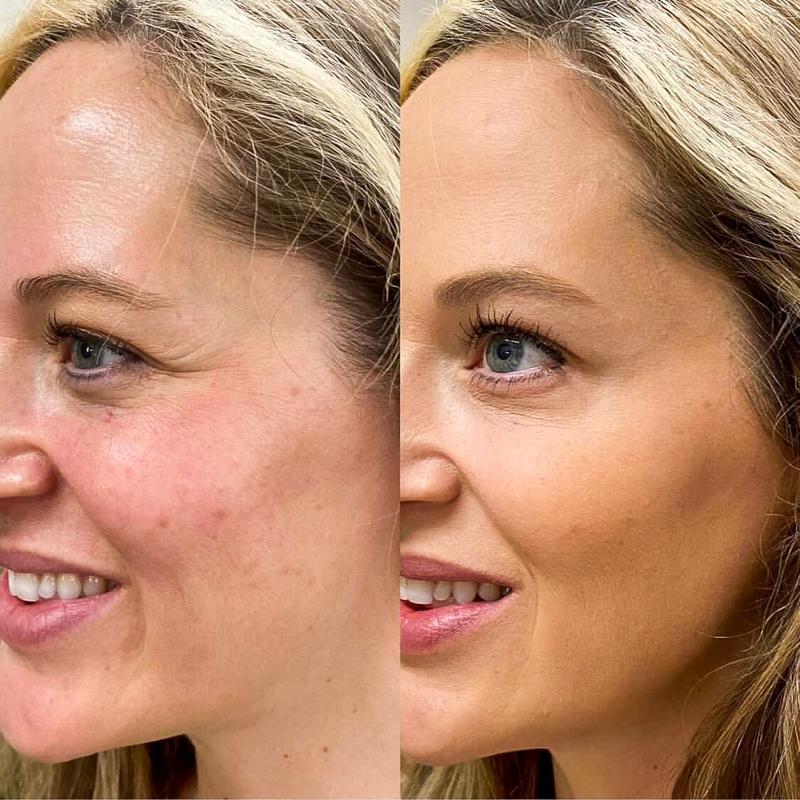 facial before or after botox